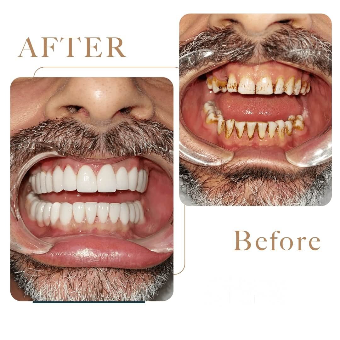Before After 4