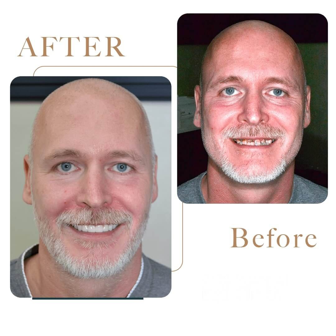 Before After 5