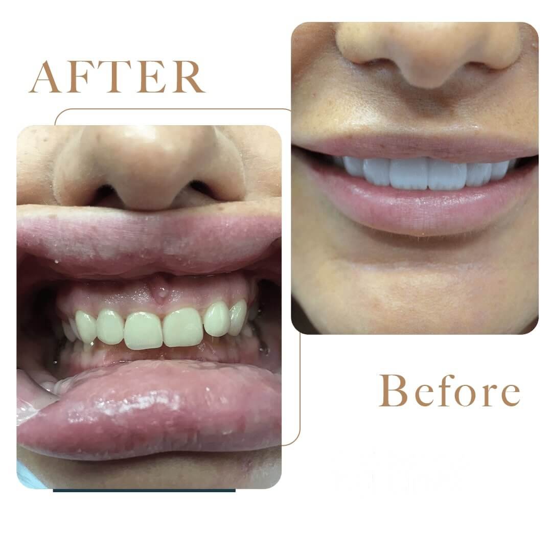 Before After 6