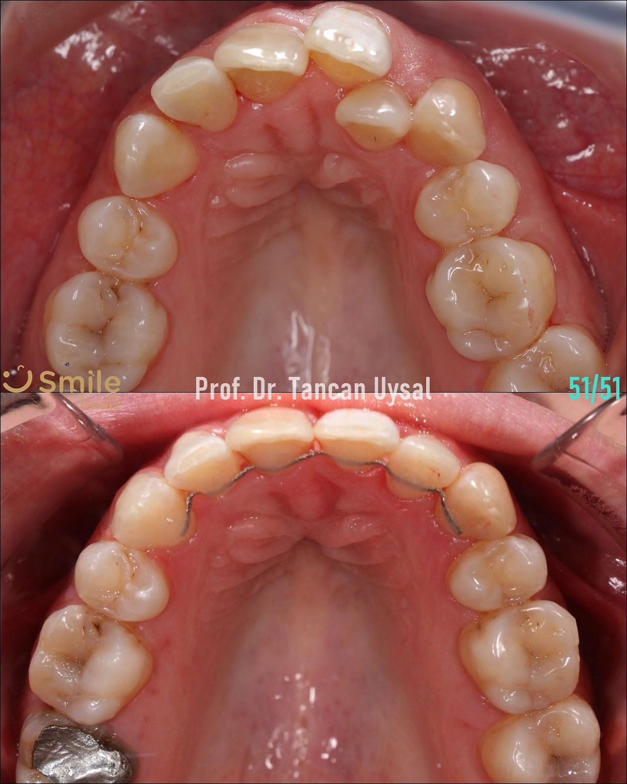 Before After 1