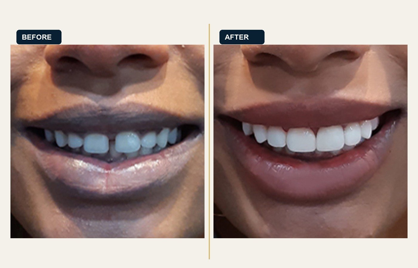 Before After 1