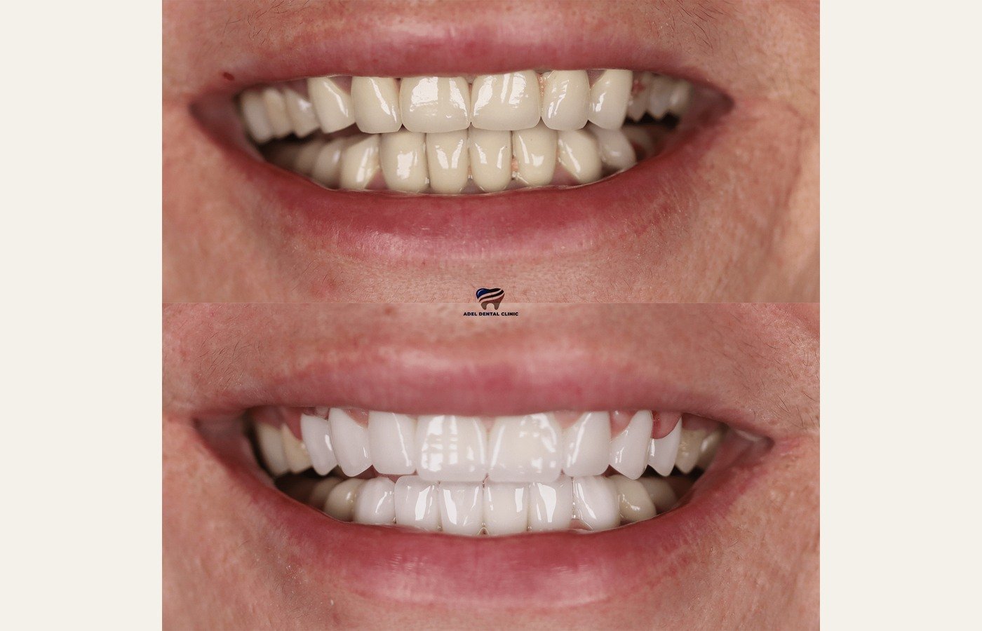 Before After 1