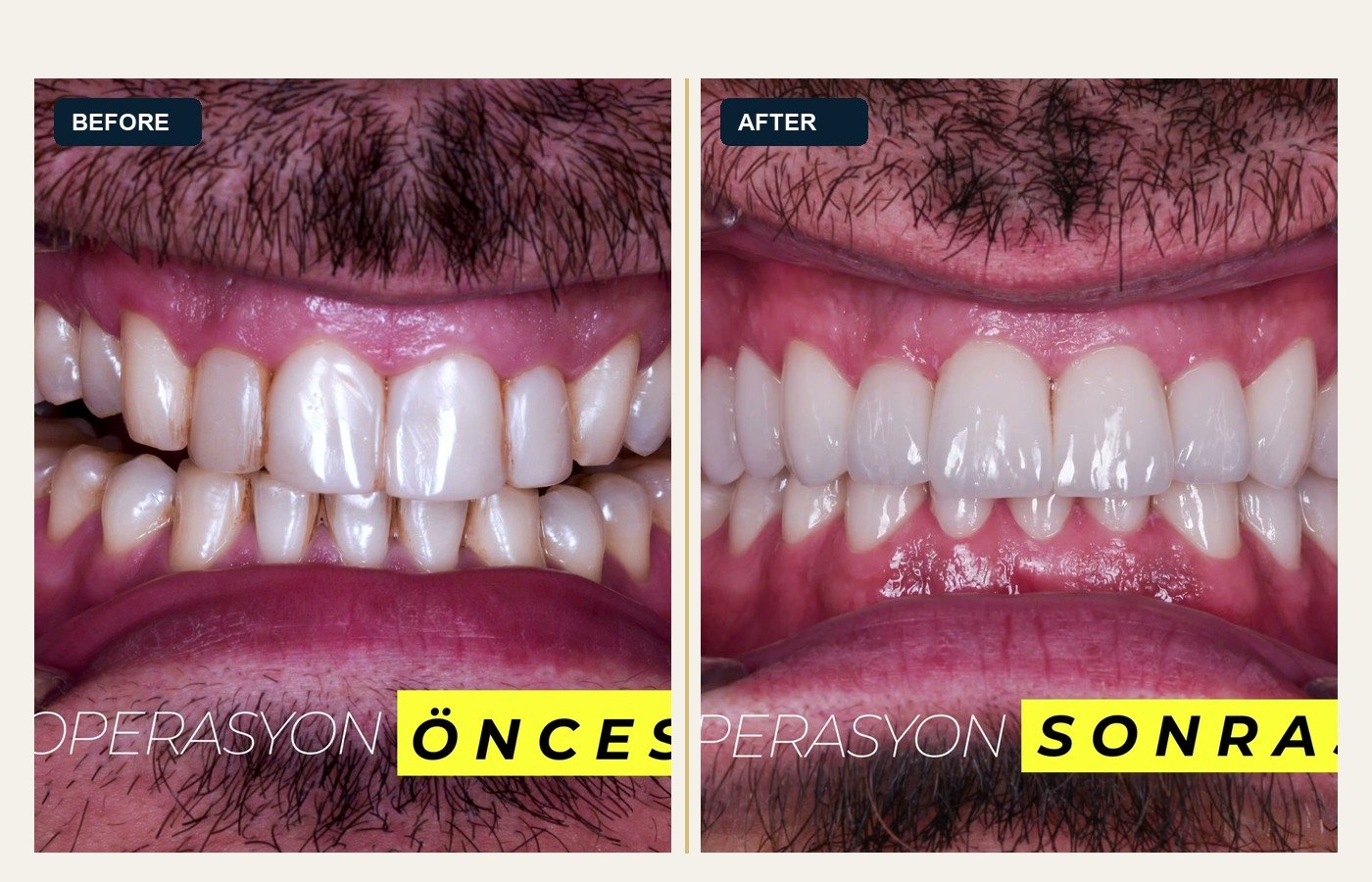 Before After 1