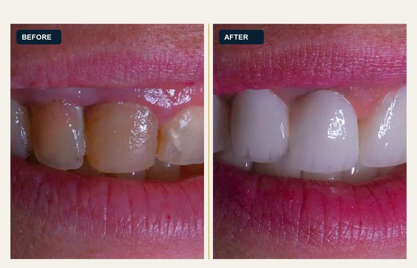 Before After 1