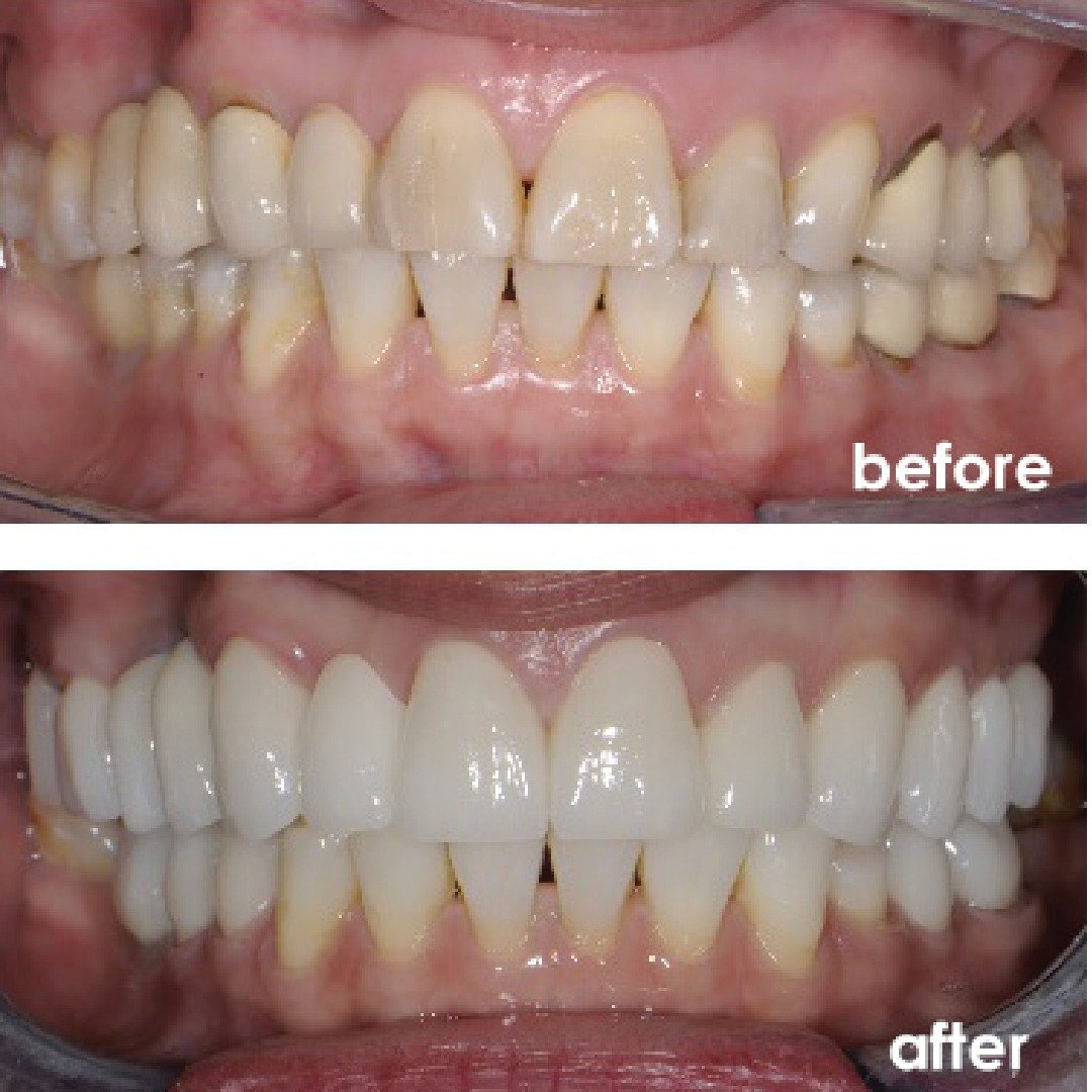 Before After 1