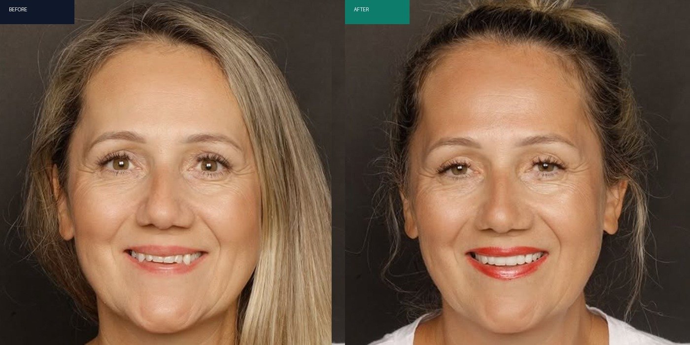 Before After 1