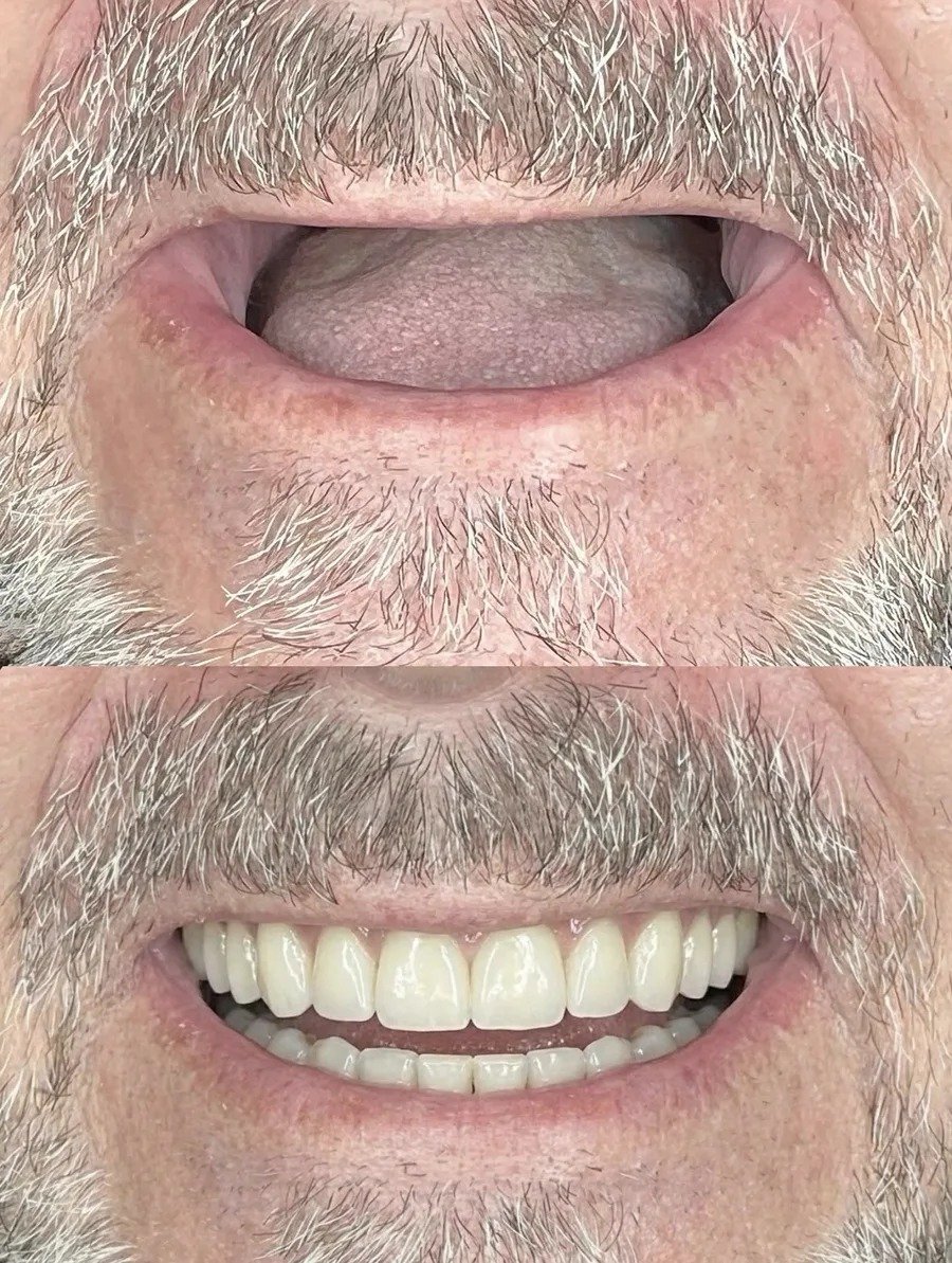Before After 1