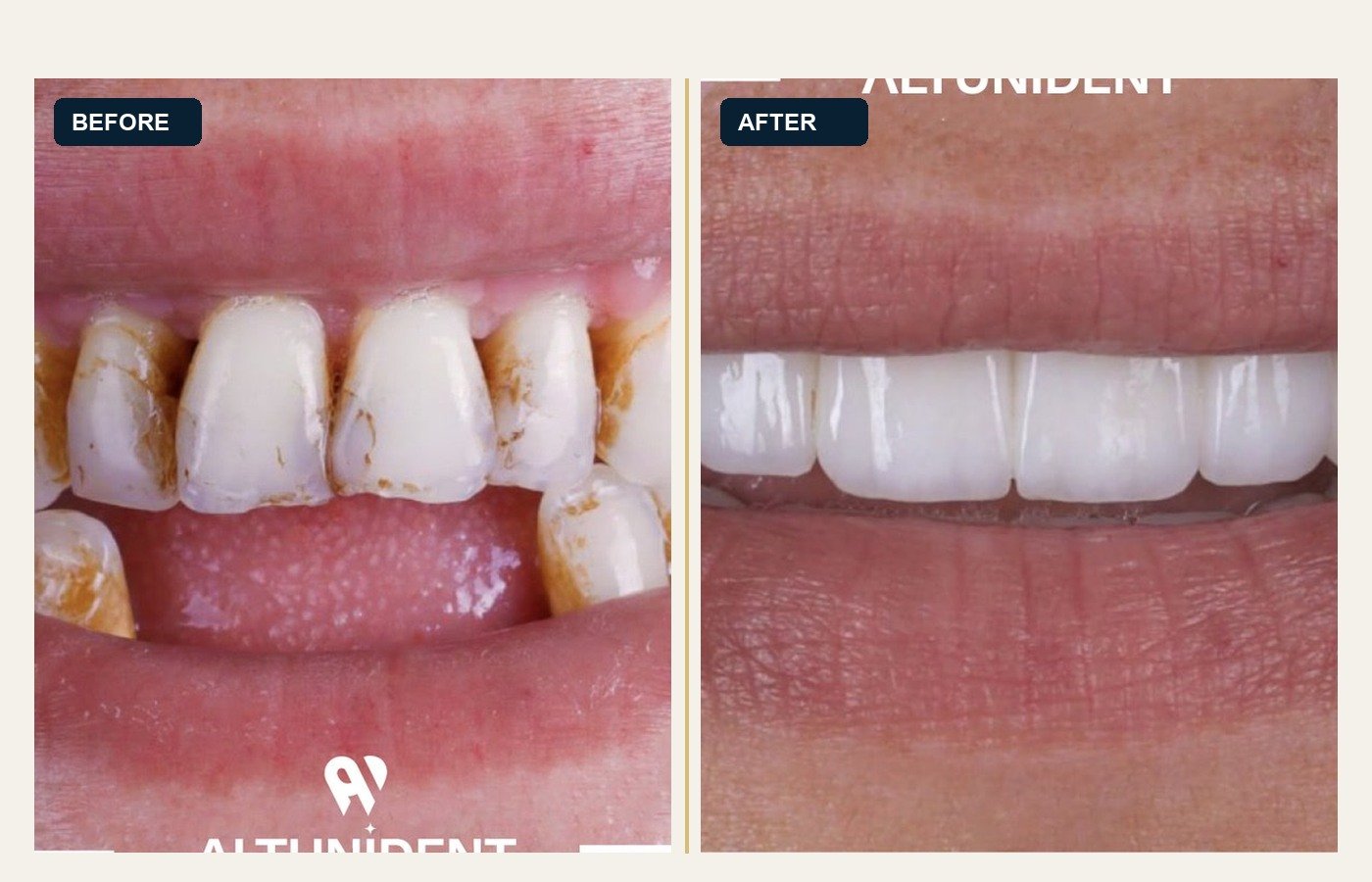 Before After 1