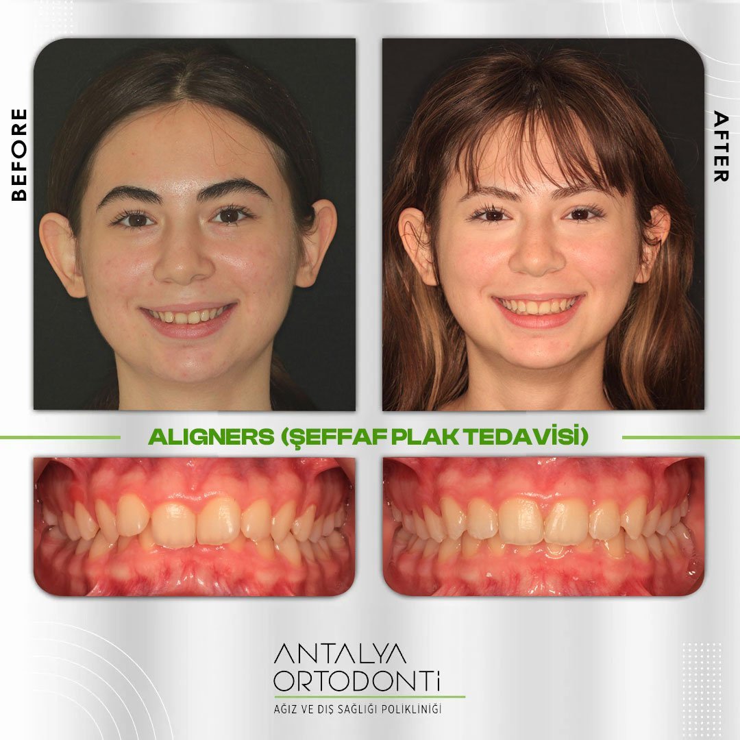 Before After 1