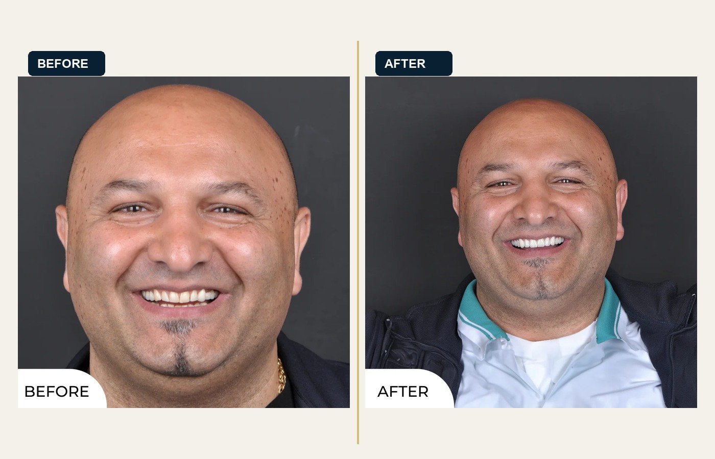 Before After 1