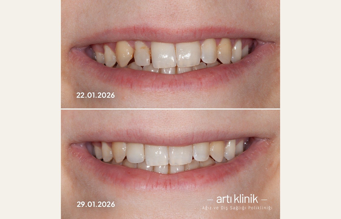 Before After 1