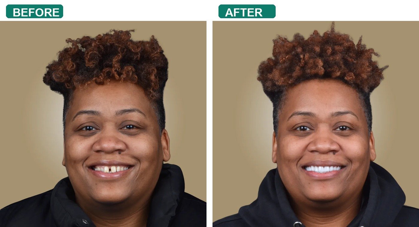 Before After 1