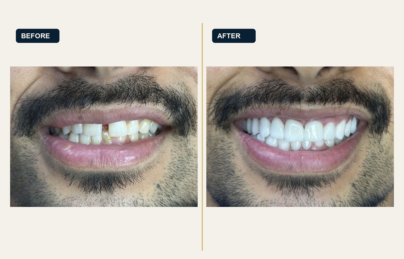 Before After 1