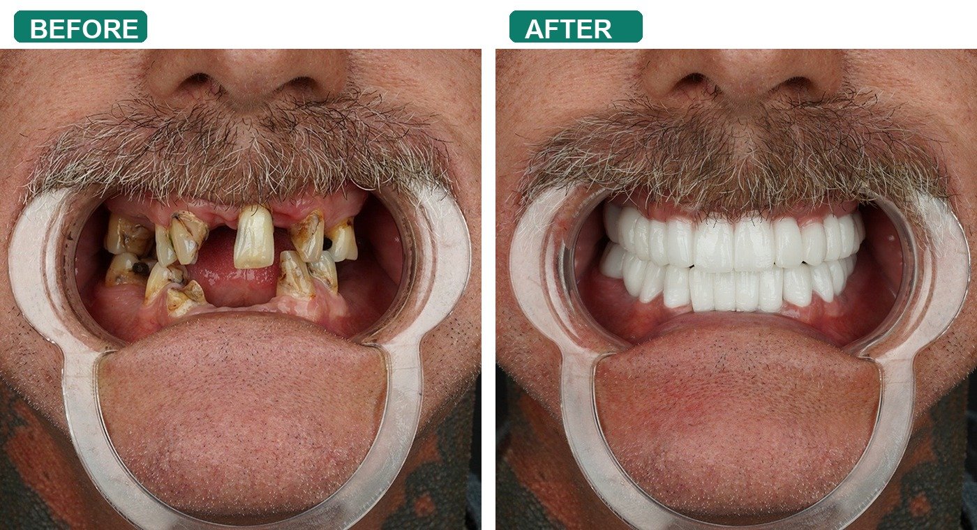 Before After 1