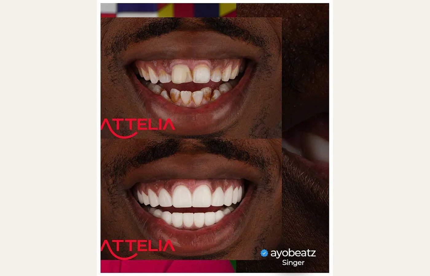 Before After 1