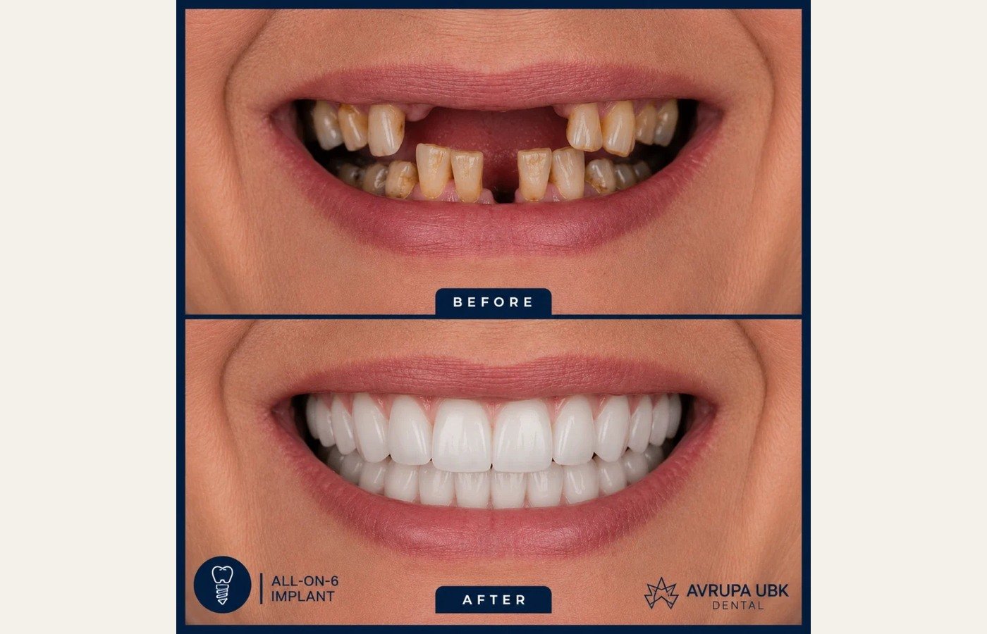 Before After 1