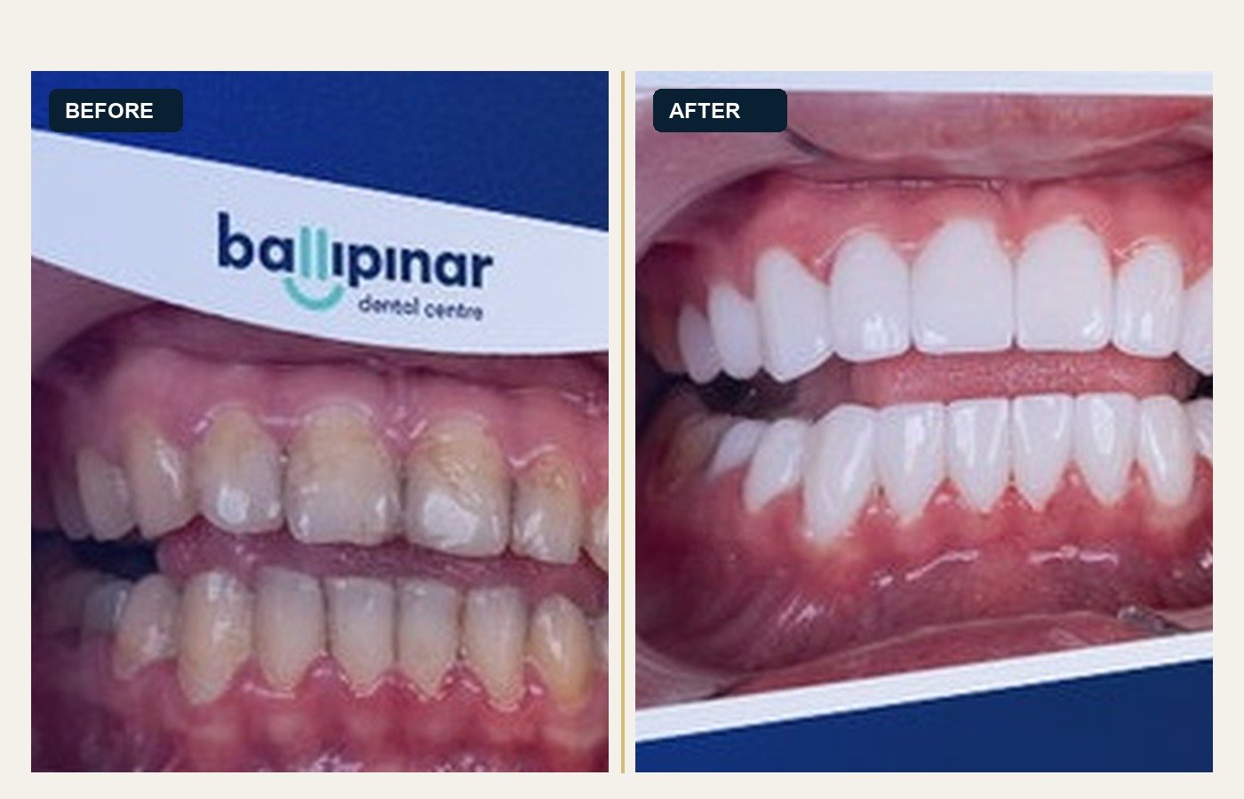 Before After 1