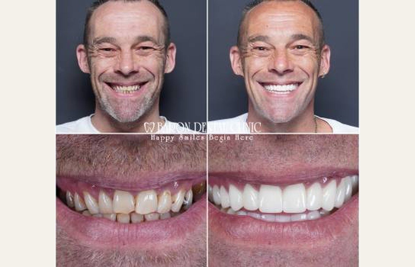 Before After 1