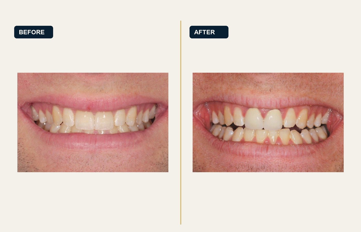 Before After 1