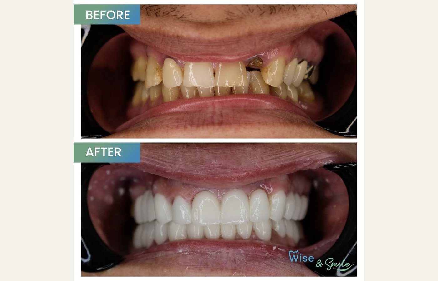 Before After 1