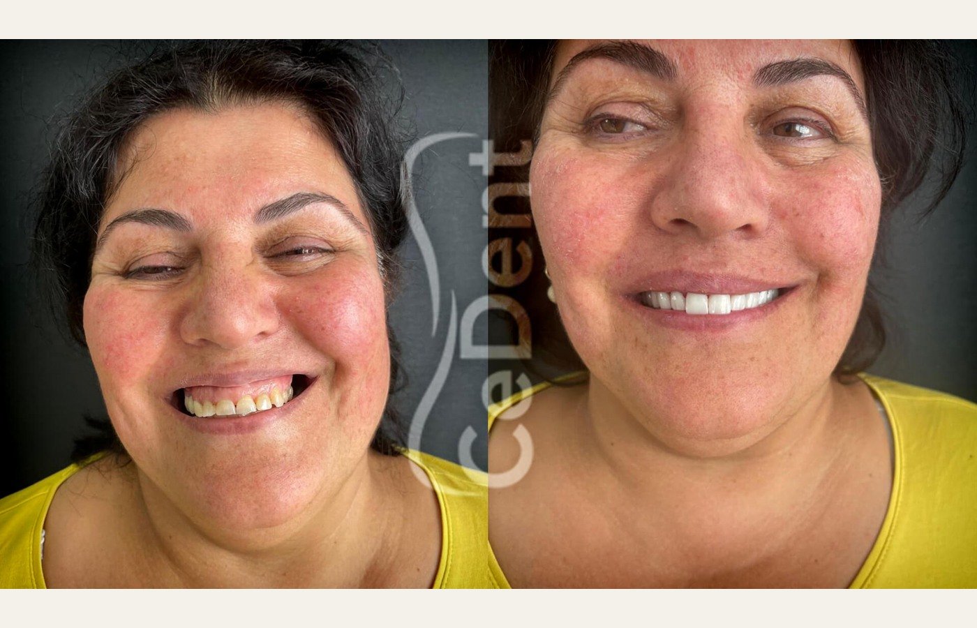 Before After 1