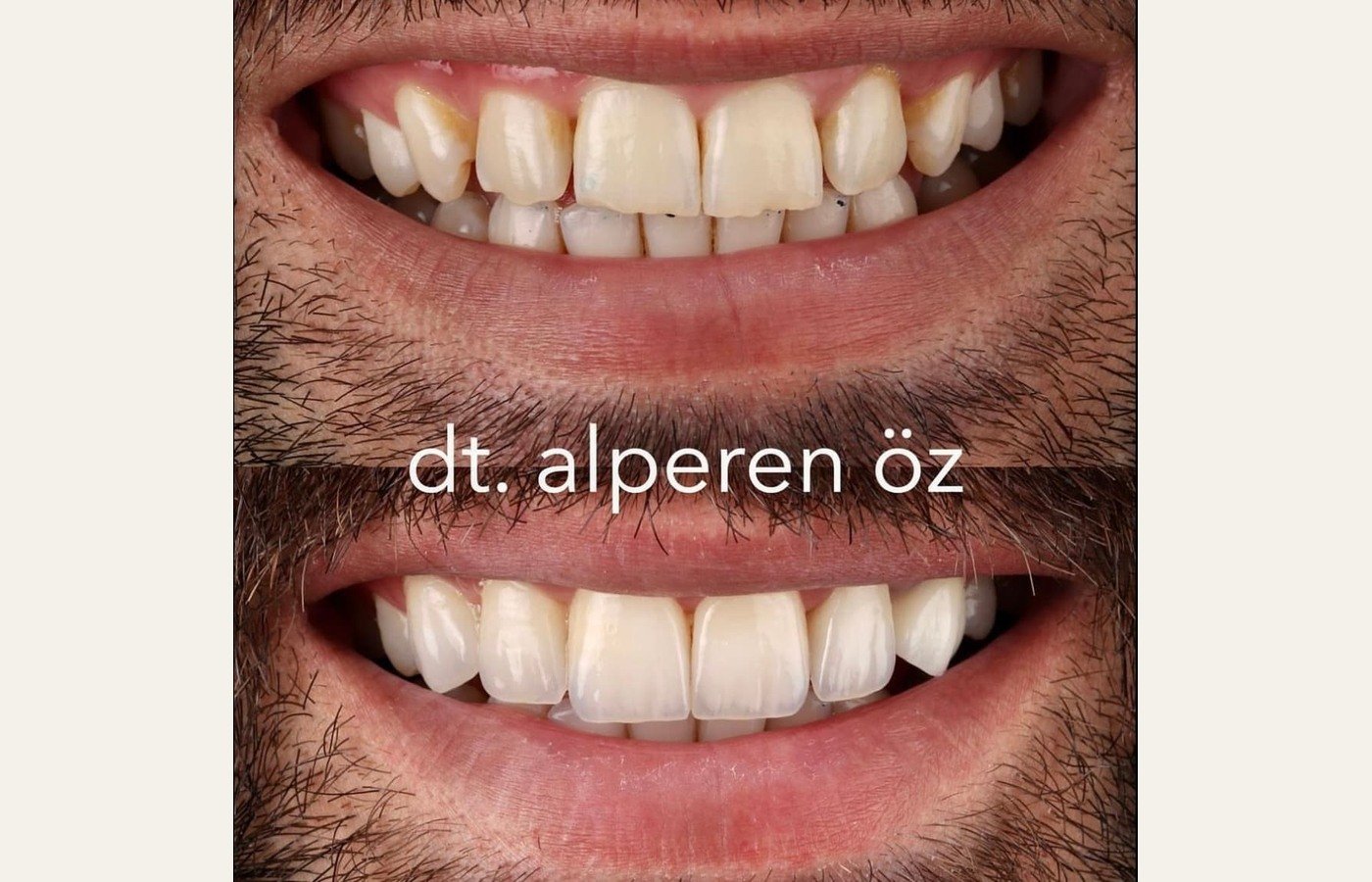 Before After 1