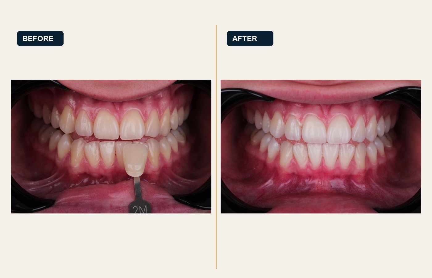 Before After 1