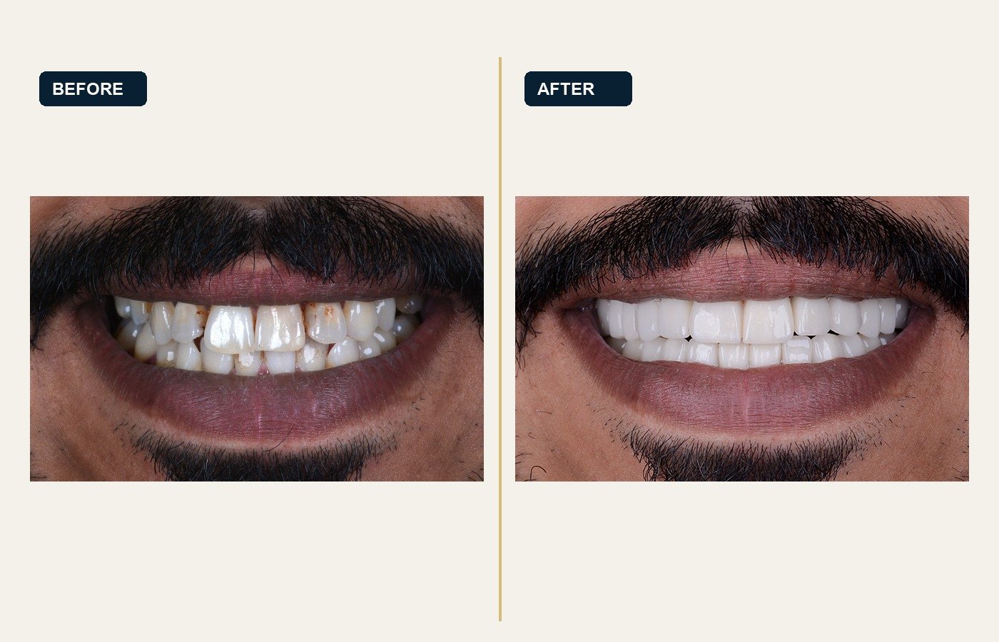 Before After 1