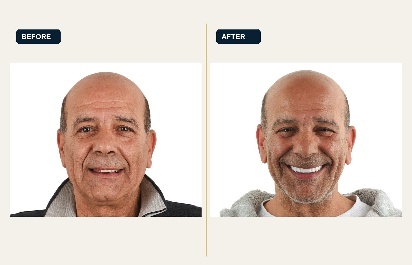Before After 1
