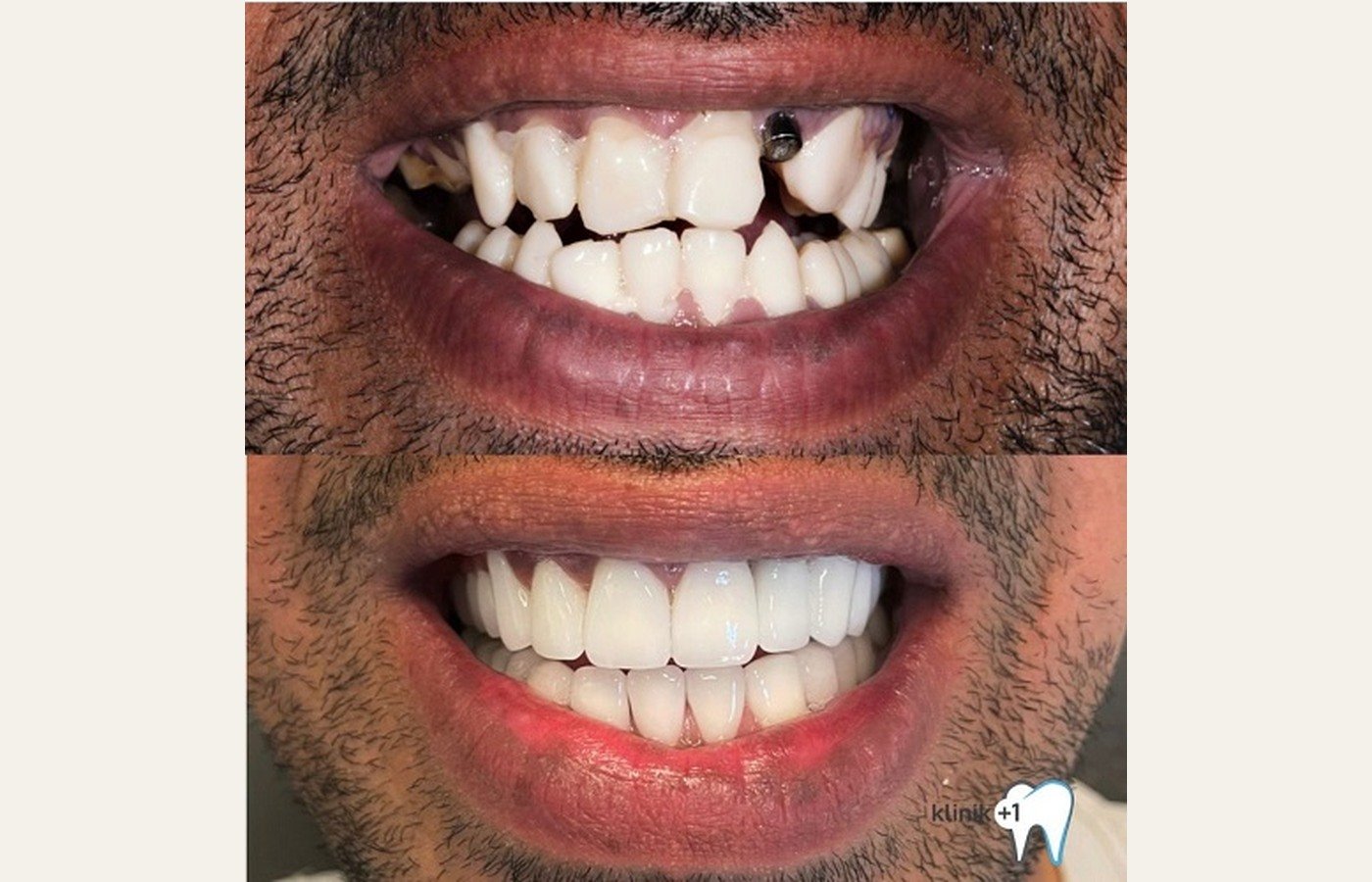 Before After 1