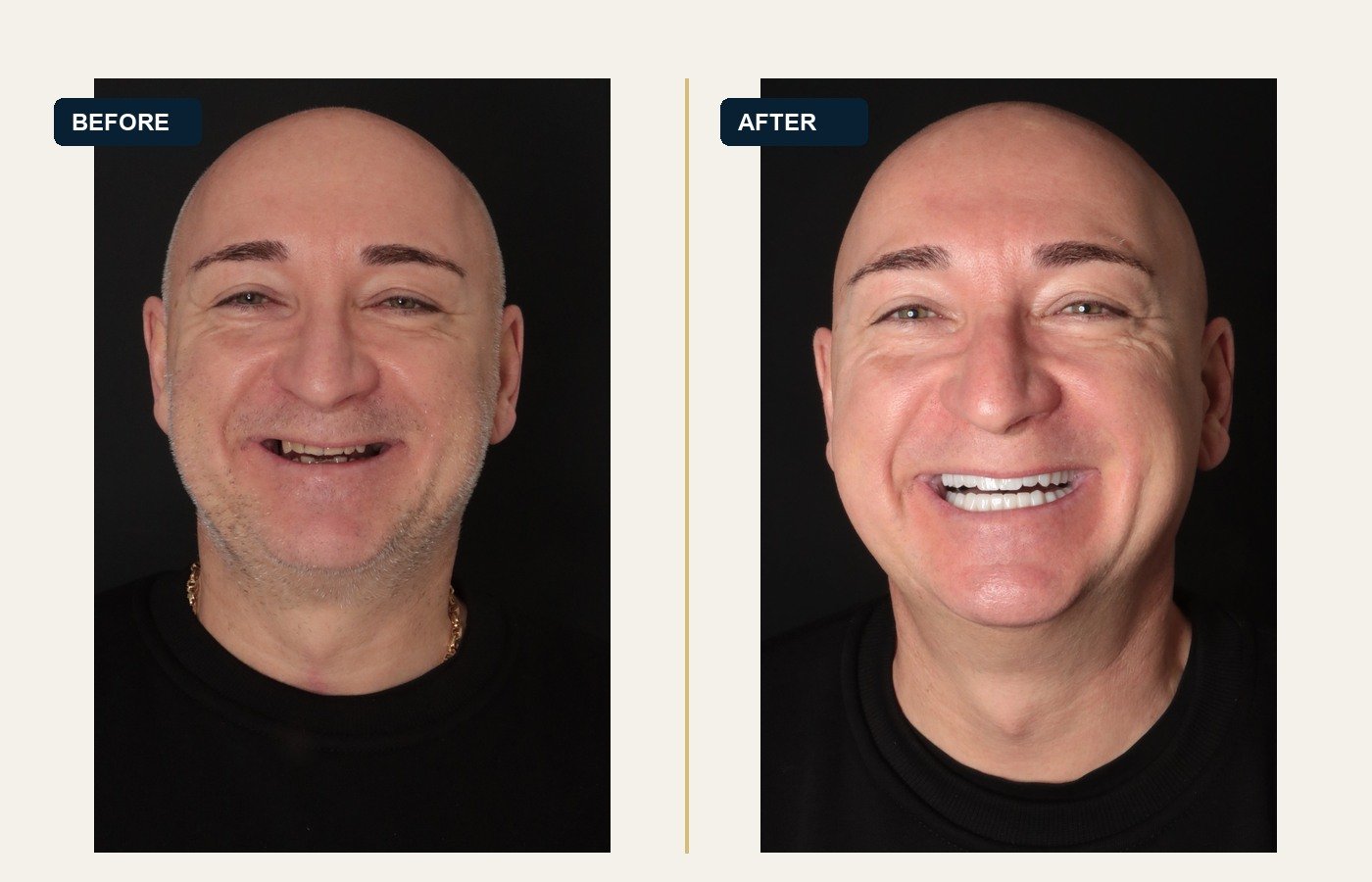 Before After 1