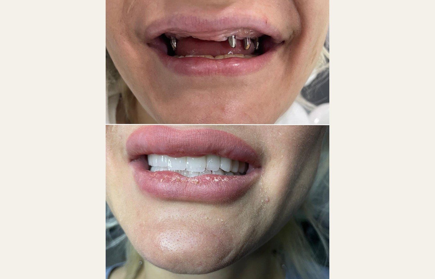 Before After 1