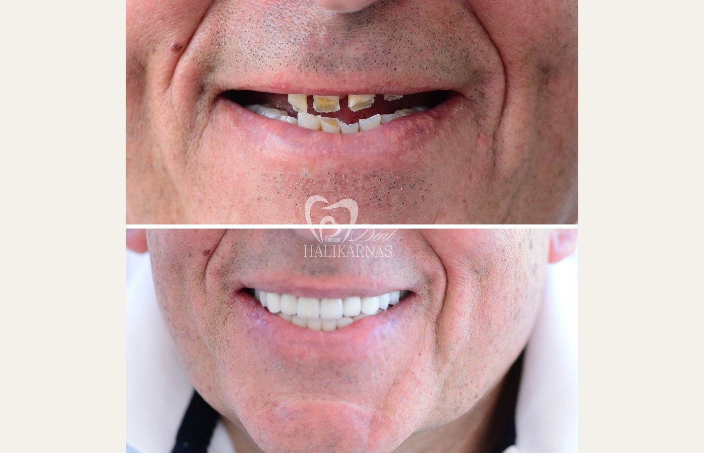 Before After 1