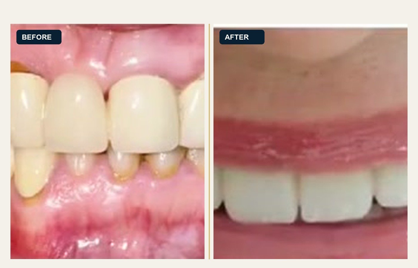 Before After 1