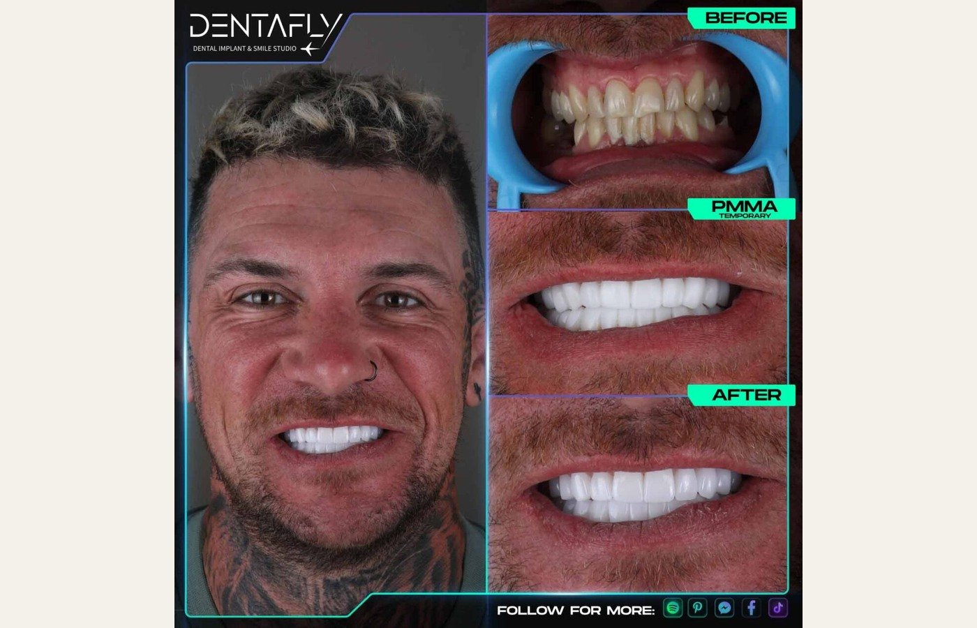 Before After 1
