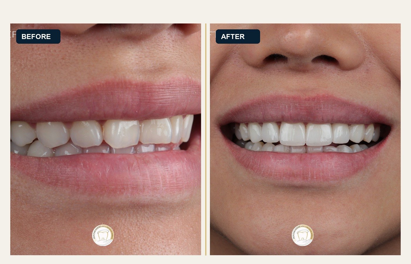 Before After 1