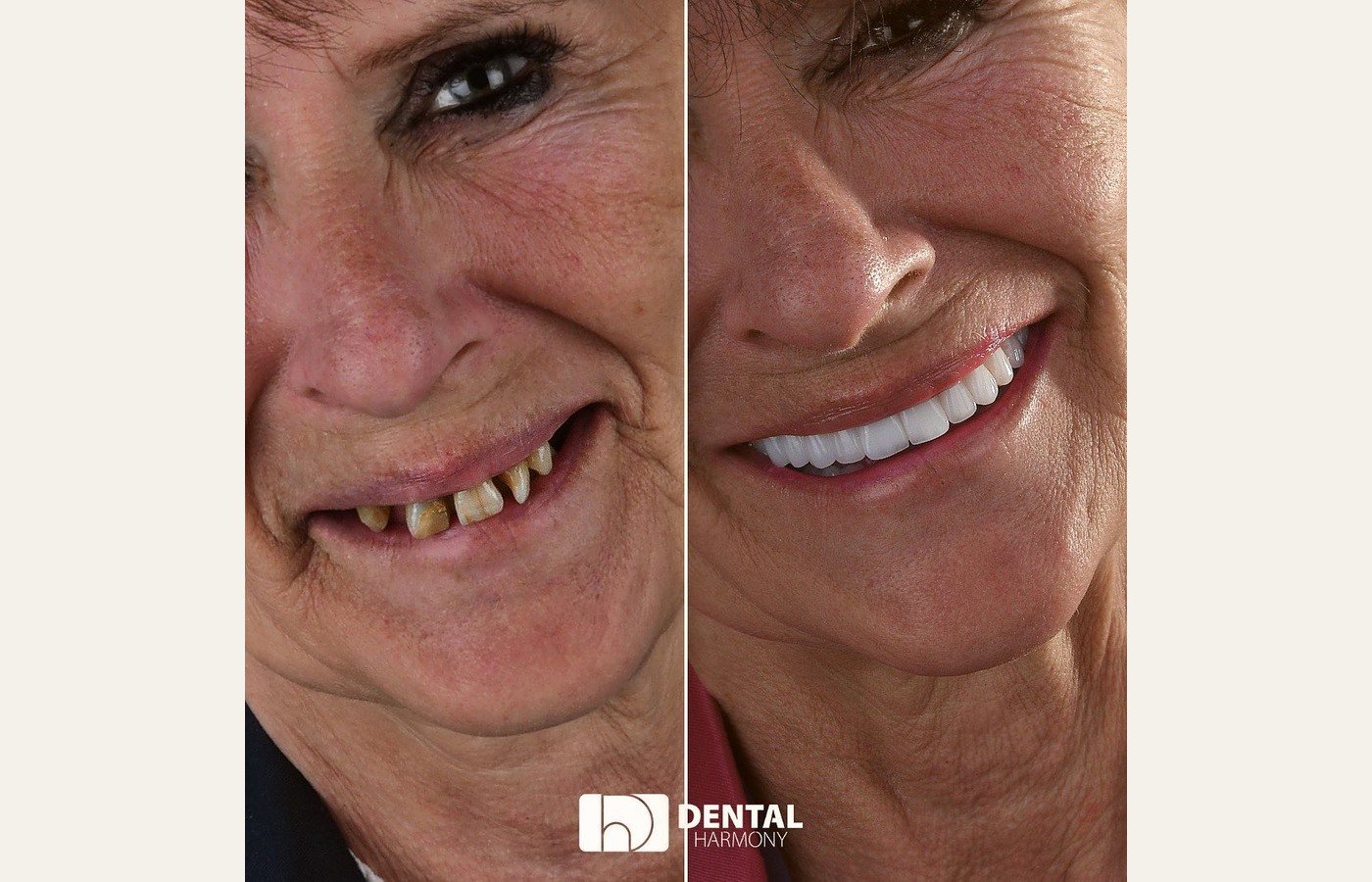 Before After 1
