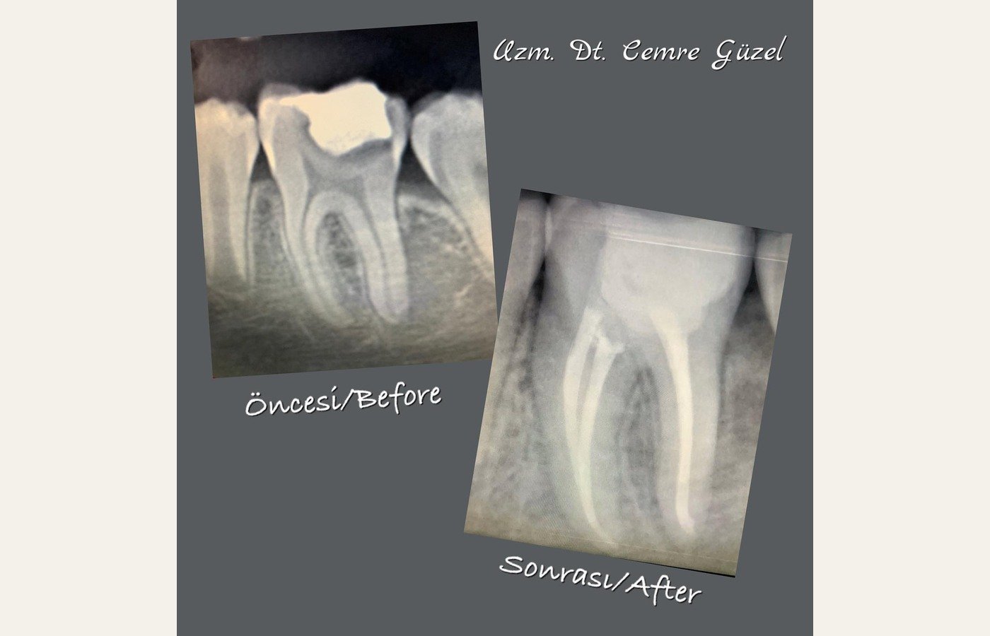 Before After 1