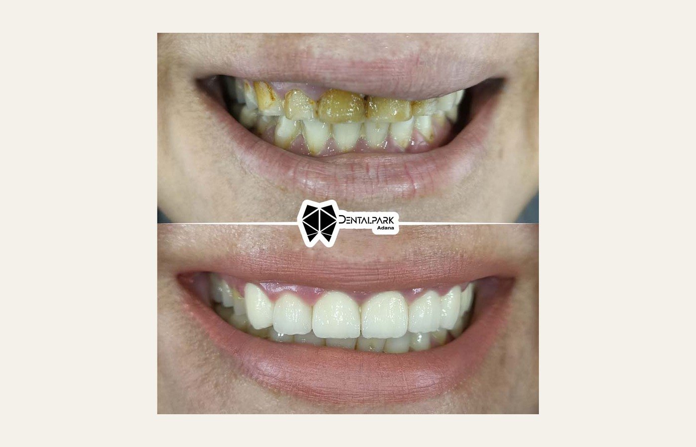 Before After 1
