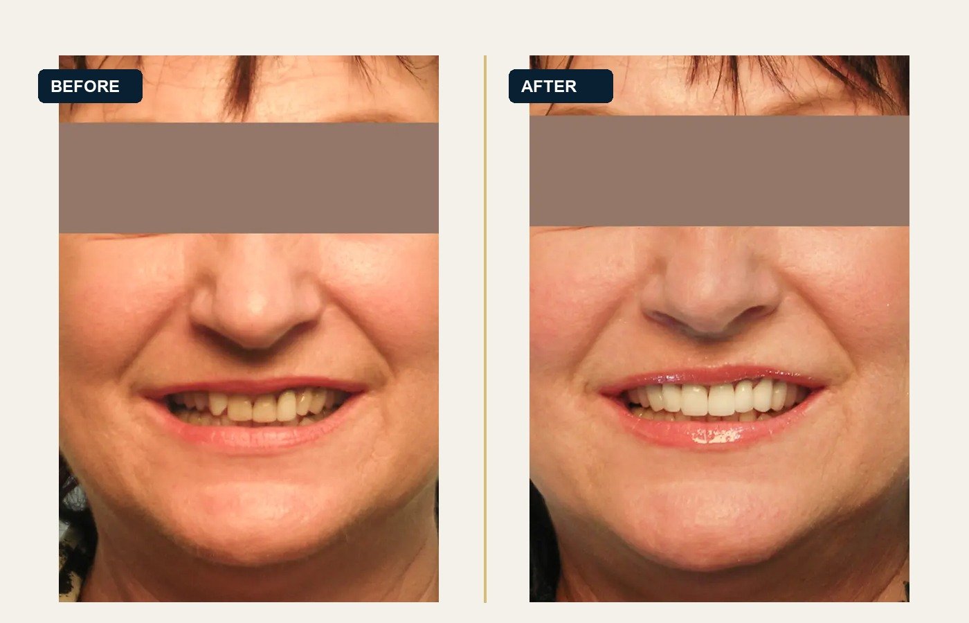 Before After 1