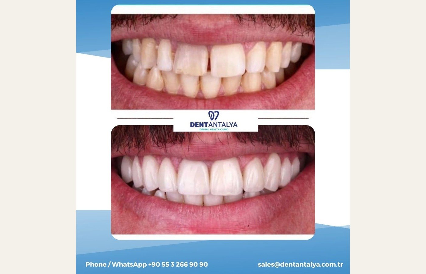 Before After 1