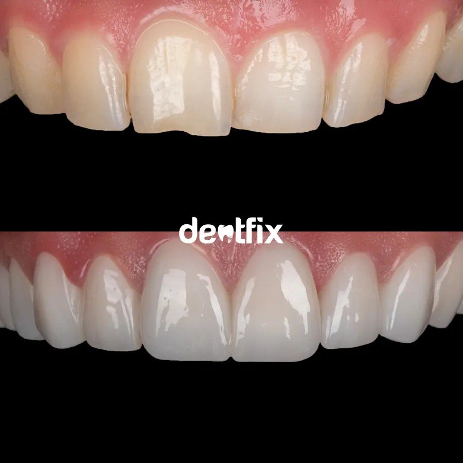 Before After 1