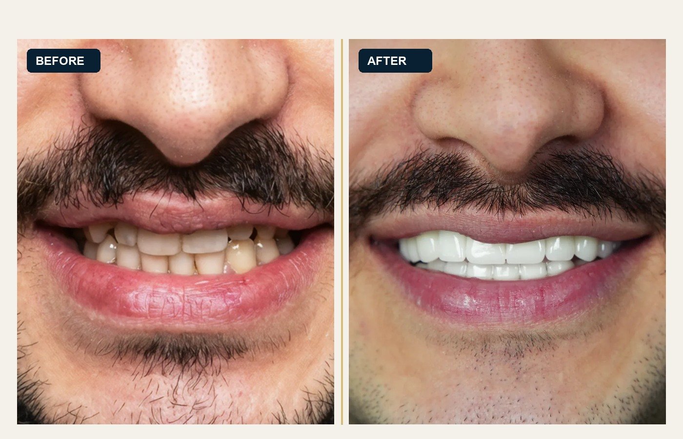 Before After 1