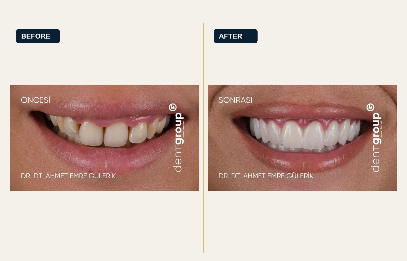 Before After 1