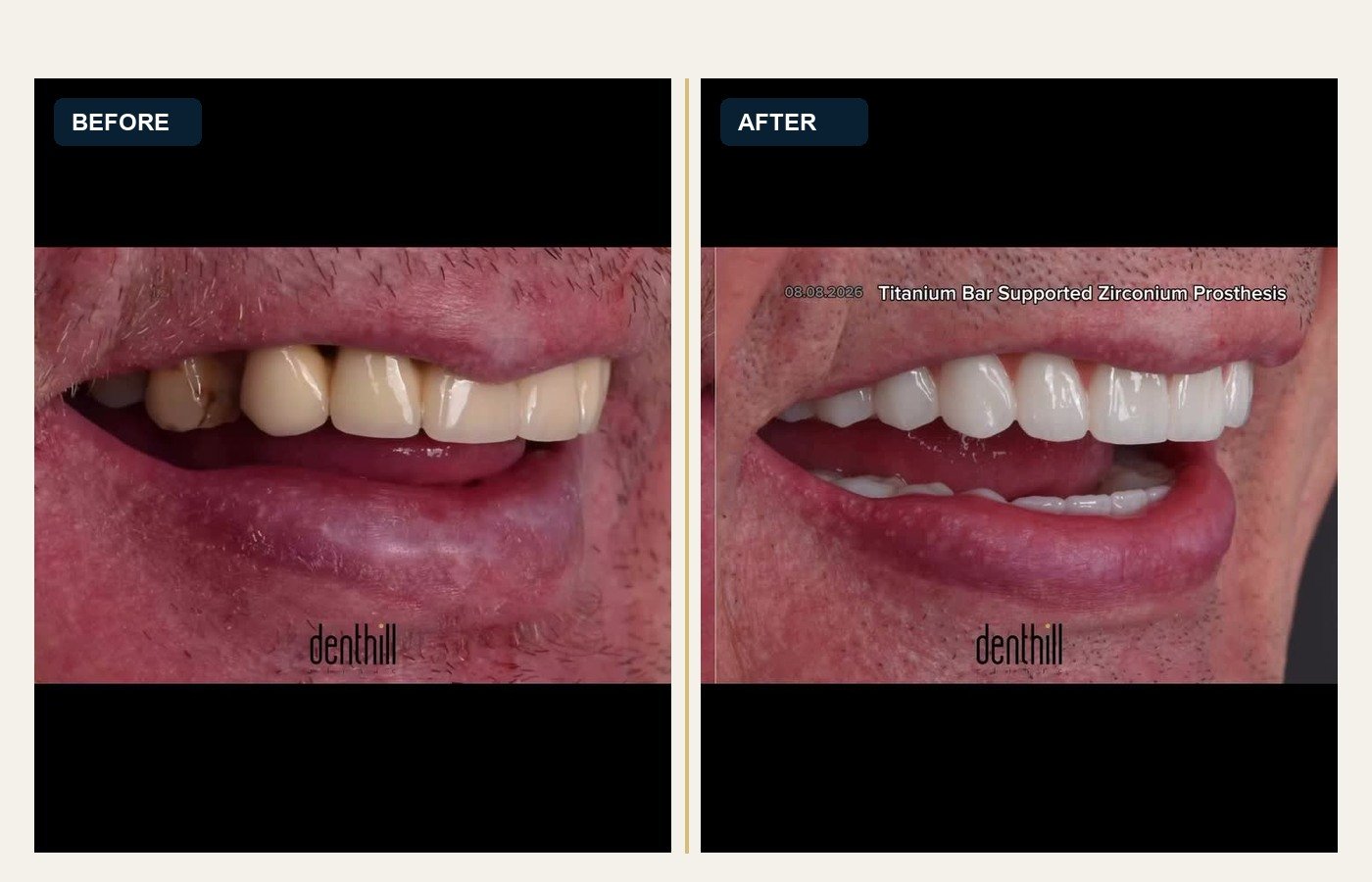 Before After 1
