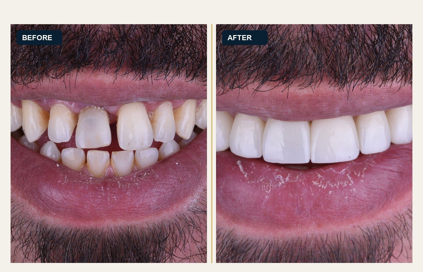 Before After 1