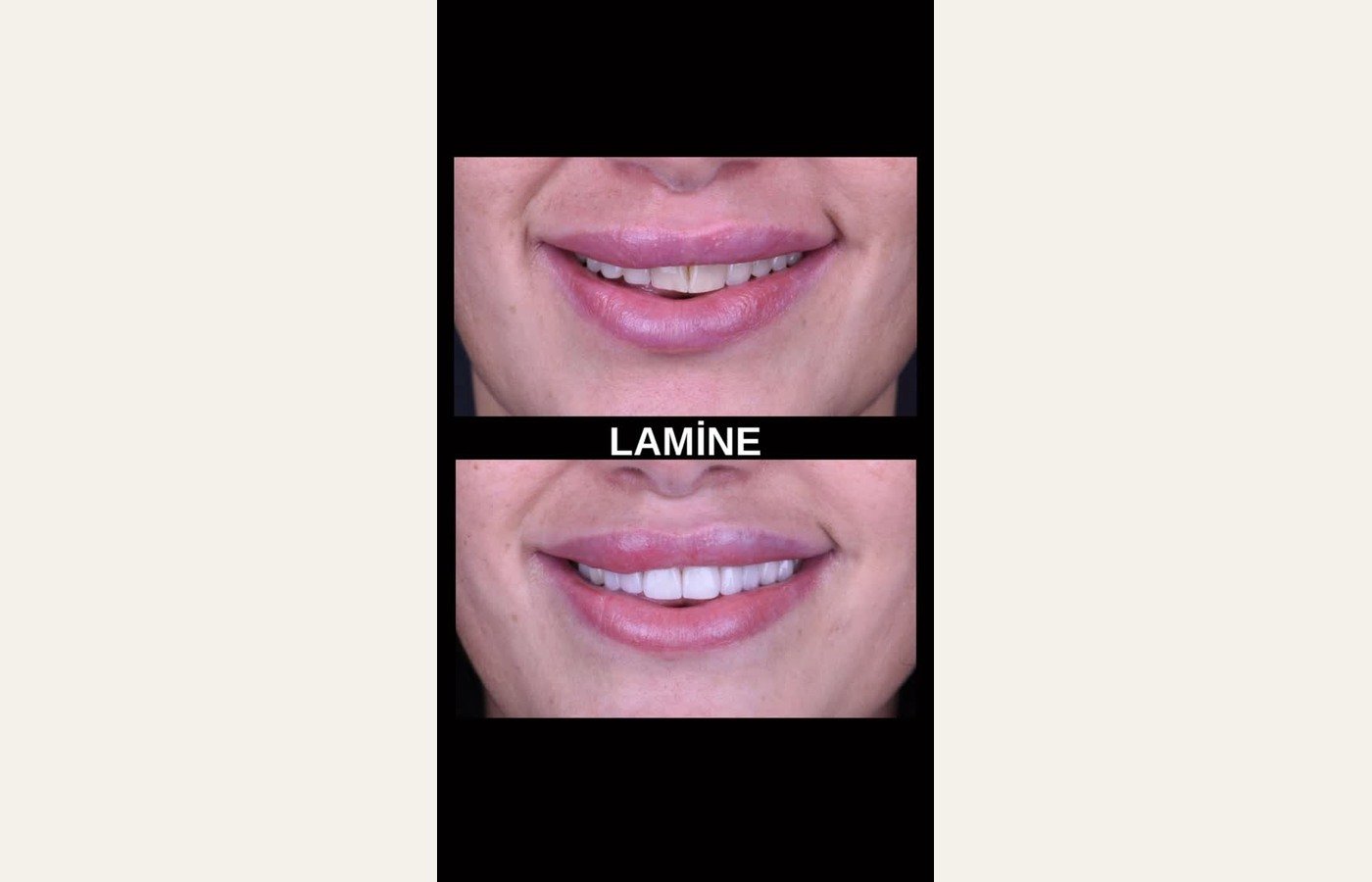 Before After 1