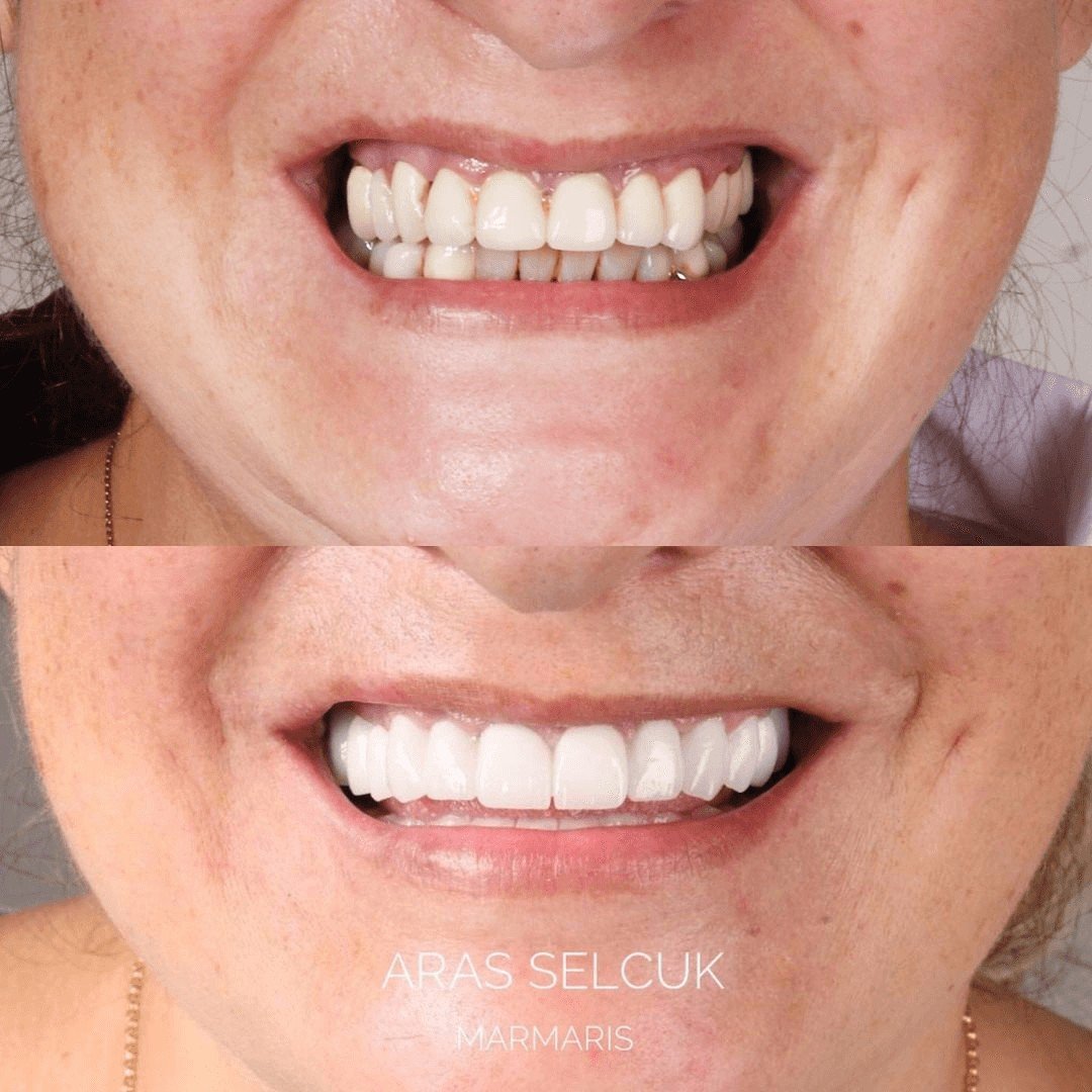 Before After 1