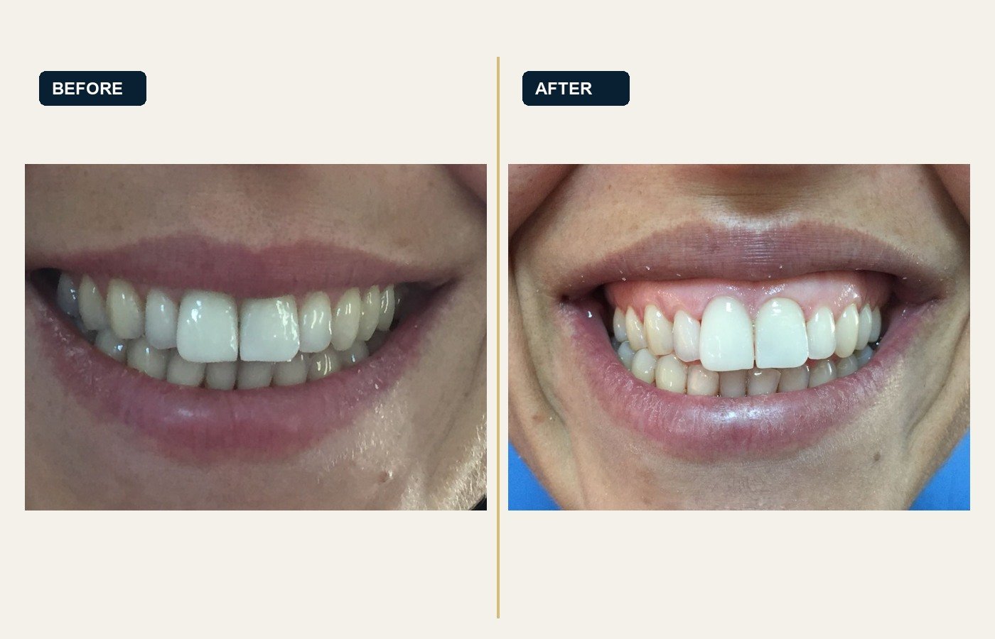 Before After 1