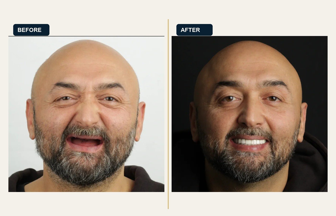 Before After 1